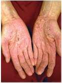 Generell behandling av eksem Hvordan beskytte huden?