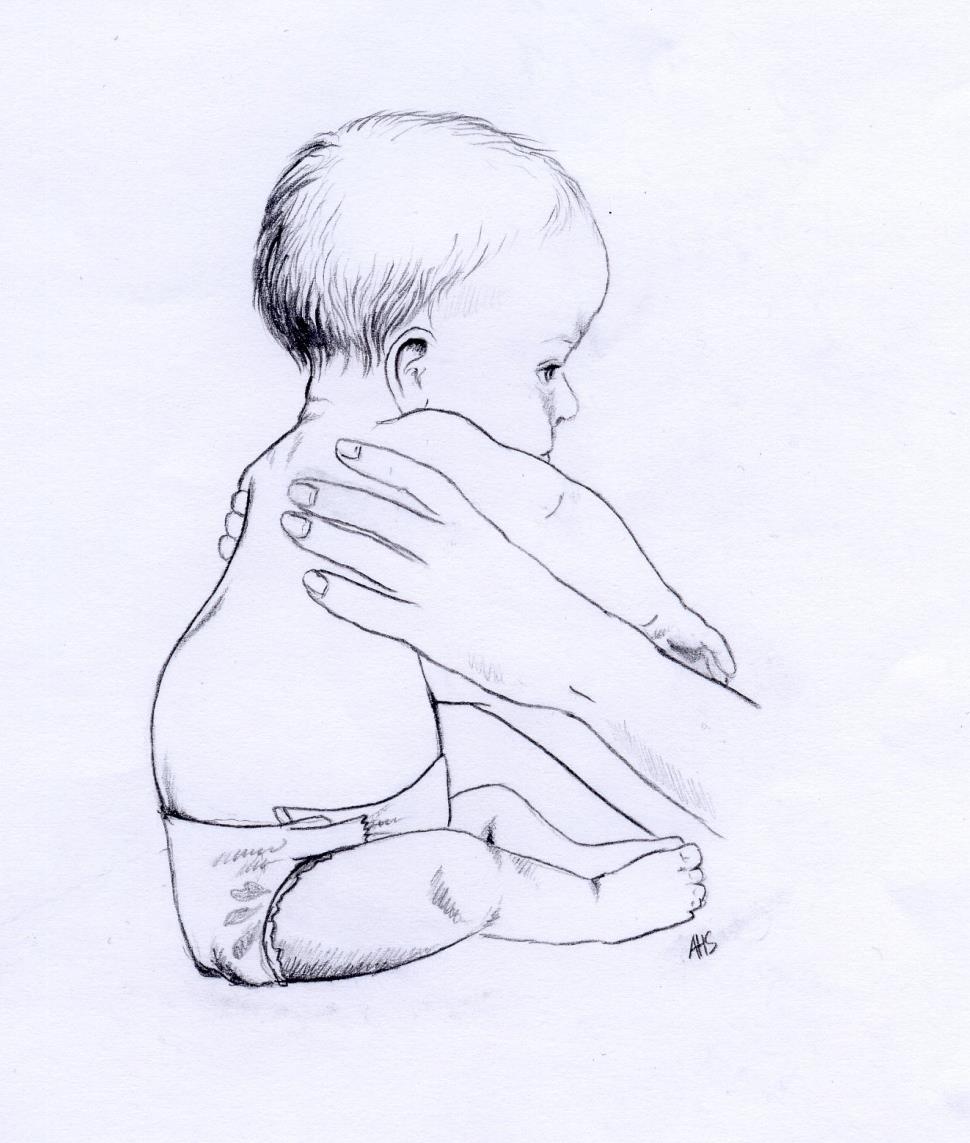 Thorakal gibbus «kul på ryggen» Vanlig ved akondroplasi Bedres vanligvis når barnet begynner å reise seg/stå