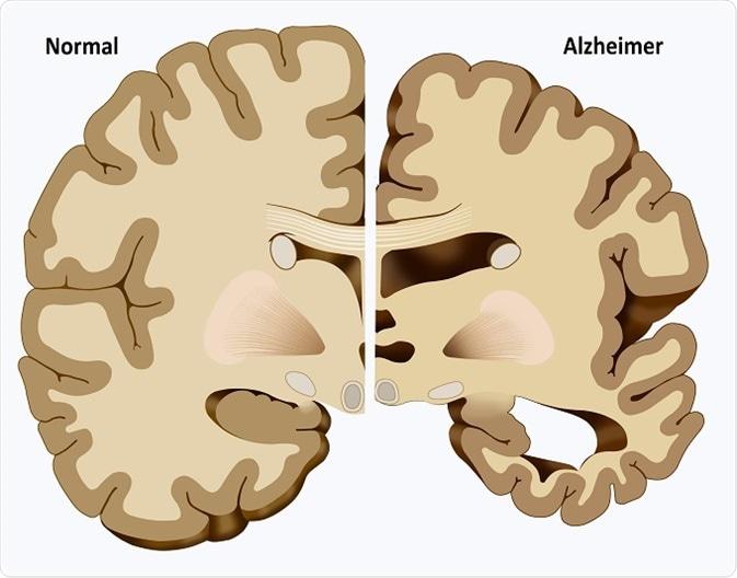 Smerte-prosessering ved aldring og demens Aldring Økt toleranse for mild smerte Redusert toleranse for sterk smerte Alzheimer s