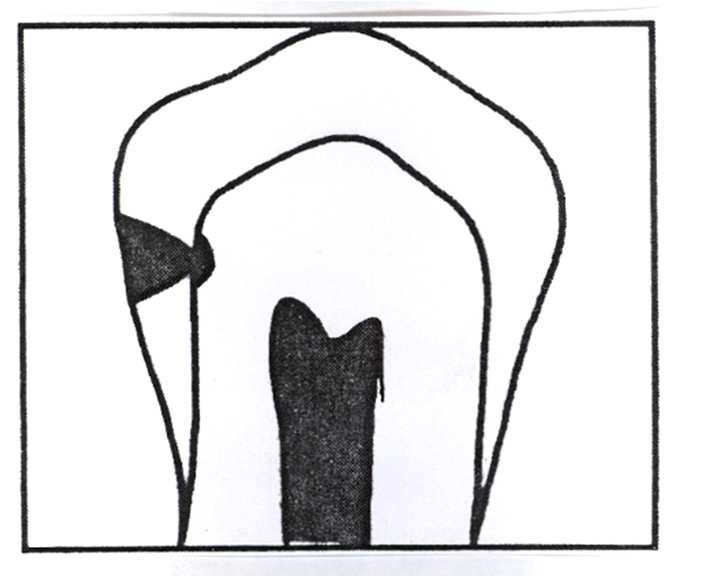 Approksimalkaries (røntgendiagnose) Grad 1 (A1): Lesjon i ytre halvdel i emaljen (inntil ½ emaljetykkelsen) Grad 2 (A2): Lesjon i indre halvdel av emaljen (inntil emalje-dentin
