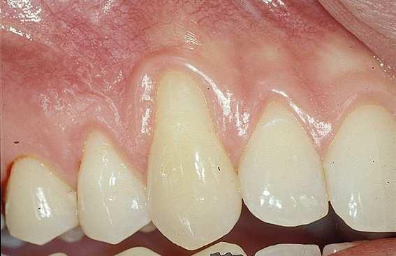 Man undersøker mulige endringer i tennenes hardvev: