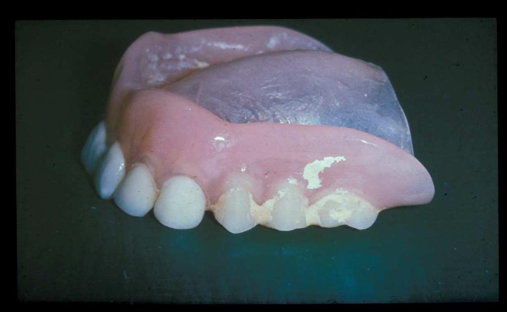 Gingivitt og periodontitt Gingivitt er en betennelse i gingiva. Gingiva blir ødematøs og det blør ved tannpuss. Gingivitt er en reversibel prosess.