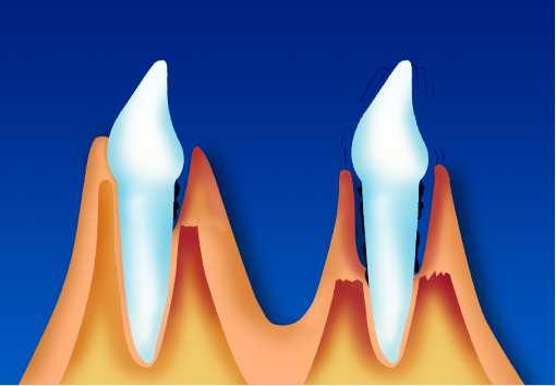 Stor blødningstendens/spontanblødning Store formforandringer kan forekomme Sonderingsdybden kan i enkelte tilfeller overstige 3 mm Marginal periodontitt PS periodontitis