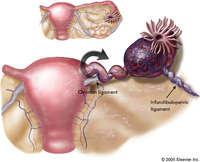 4. Torsjon av ovarier Sjelden,også hos ikke IVF pasienter Symptomer Kraftige, takvise krampaktige smerter +/ kvalme og oppkast Diagnostikk Klinisk diagnose Kan observere redusert/opphørt sirkulasjon