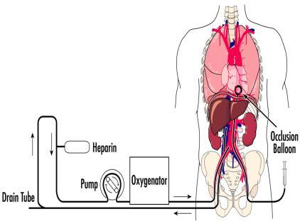 cdcd med normotherm ECMO (controlled Donation after Circulatory Death) I 2015 gjennomførte OUS 6 kontrollerte DCD med bruk av Ekstra Corporal Membran Oksygenator (ECMO) hos pasienter som døde av