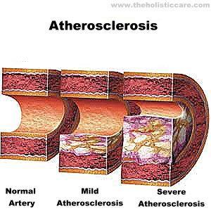 Atherosclerosis timeline The process of atherosclerosis begins in childhood (1, 2, 3) 1)