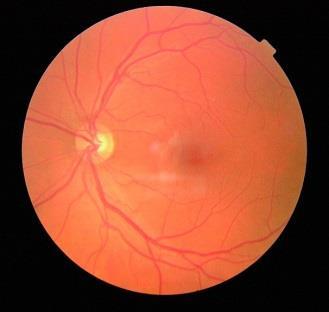 RETINOPATI, 2016 Andel pasienter som har: % (n) - har non-proliferativ retinopati 0,7% (18) 1 av disse