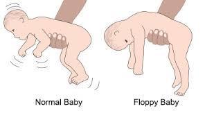 Effektar på foster/barn av benzo: Ved benzobruk til fødsel: Floppy infant syndrome hos nyfødd Hypotoni,hypotermi,pustevanskar,dievanskar Sprikande funn ifht risiko for