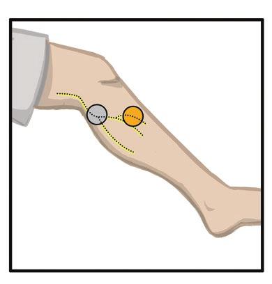 7. La pasienten sitte og strekke ut beinet til mellom 15 og 20 graders fleksjon. (Pasienten må beholde denne posisjonen gjennom hele tilpasningsprosessen.) Hælen skal heves hvis mulig. 8.