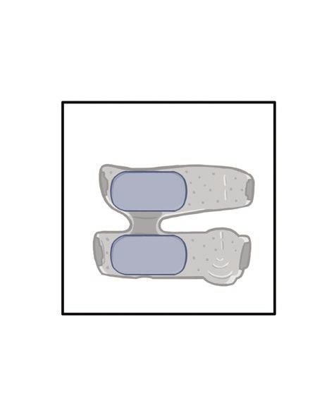 2 4 5 6 Figur 8-17: Tilpasse lårtekstilelektrodene Sette på FS-lårmansjetten Slik setter du på FS-lårmansjetten: 1. Få pasienten til å sitte i en stabil posisjon på kanten av en stol. 2.