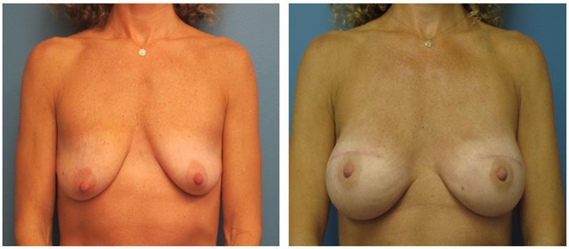 Fordeler ved primær rekonstruksjon Bevarer brystets «fotavtrykk», hud og evt.