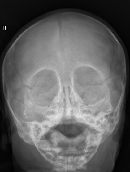 Craniosynostose Røntgen caput Vi anbefaler