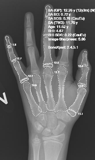 Røntgen hånd-skjelettalder Bonexpert Automatisert bestemmelse av skjelettalder Kan estimere slutthøyde