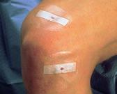 Redusert risiko for infeksjoner sammenlignet med bruk av hudstifter (1,2)* Mange størrelser tilpasset de fleste sår Bruksområder Primærlukking av kutt og lukking av kirurgiske innsnitt