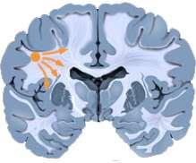 Fokale anfall Fokale anfall starter i et nettverk av hjerneceller i et avgrenset område av den ene hjernehalvdelen.