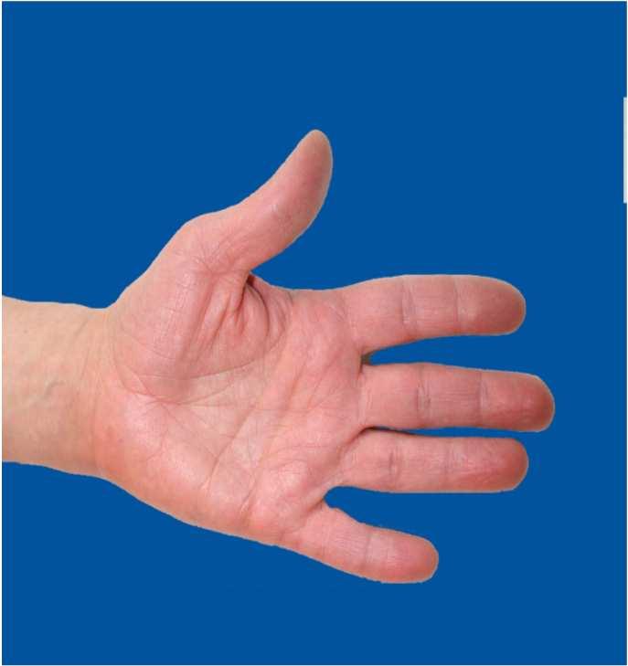 Dine 5 anledninger for håndhygiene Rengjør alltid hendene: Før rene/aseptiske oppgaver Før kontakt med pasienten eller gjenstander i pasientens nærmeste