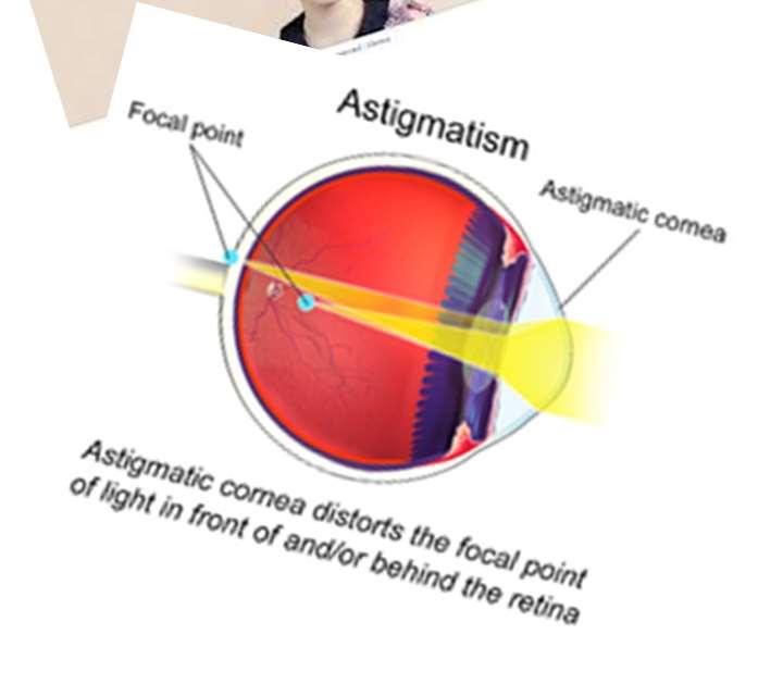 Klassifisering Strabisme Anisometropi Meridional