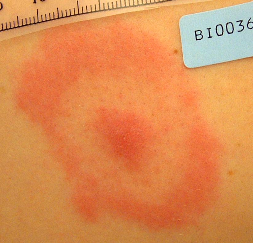 Erythema migrans-