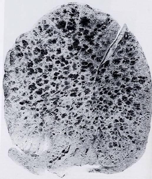 Fraser and Paré s Diagnosis of Diseases of the Chest.