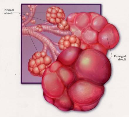 Panlobulaarne emfüseem Keskmise