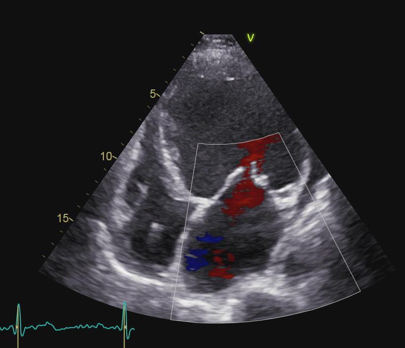 Klaffefeil Cardiac output og SVRI blir «alltid» korrekt Venstresidige