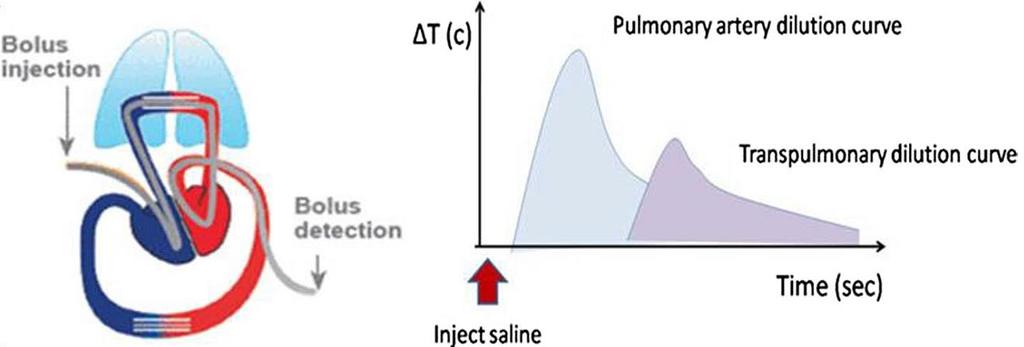 PiCCO -Pulse index Continous Cardiac Output 1)