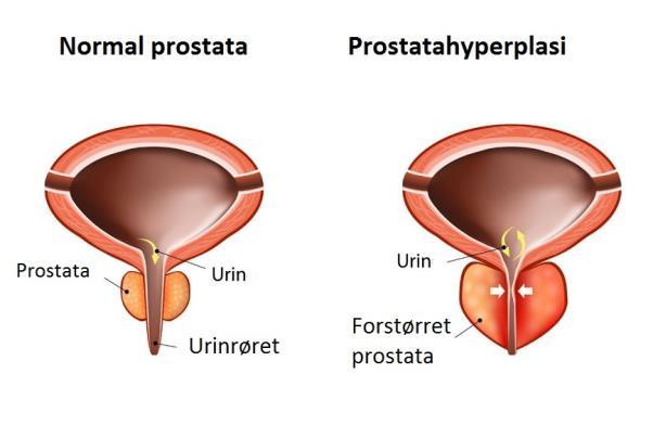 Benign prostatahyperplasi - Side 130 Godartet forstørrelse (hyperplasi) av prostata. Vanlig hos de fleste menn > 50-60 år.