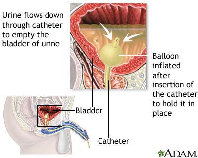 Urinlekkasje fra en overfylt blære, ofte pga avløpshinder i urinrøret som f.eks. en stor prostata.
