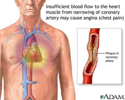 Angina pectoris (hjertekrampe) Bind 1 s 45 Smerter i brystet pga for lite blodtilførsel til hjertemuskulaturen. Oksygenbehovet i hjertet er større enn tilbudet og det oppstår oksygenmangel iskemi.