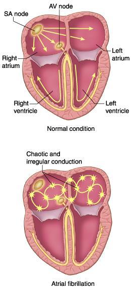 Rytmeforstyrrelser oppstått i ventriklene er mer alvorlige Impulsledningen hjerteblokk.