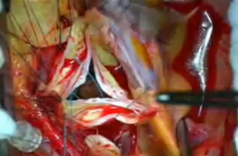 Video Skifte av aortaklaff http://www.youtube.com/watch?v=jph5nwnfgqk Øvingsoppgaver 1. Hva er hypertensjon og hvorfor bør vi behandle det? 2.
