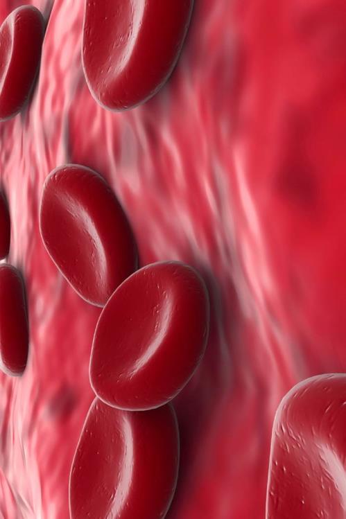 Anemi pga blødning Akutte blødninger Akutt blødning over 1,5 liter medfører sirkulasjonssvikt med lavt blodtrykk. Kroniske blødninger Kroniske blødninger medfører ofte jernmangelanemi.