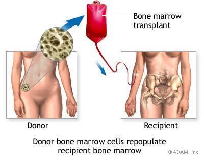 Benmargstransplantasjon Benmargstransplantasjon er mulig behandling ved noen typer leukemier.