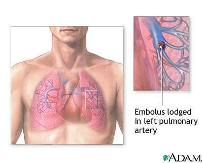 Lunge emboli Øvingsoppgaver - blodsykdommer 1. Definer anemi 2. Nevn de vanligste årsakene til anemi. 3. Hva er årsaken til at noen får jernmangel? 4. Hvem er det som ofte får vitamin B12-mangel? 5.