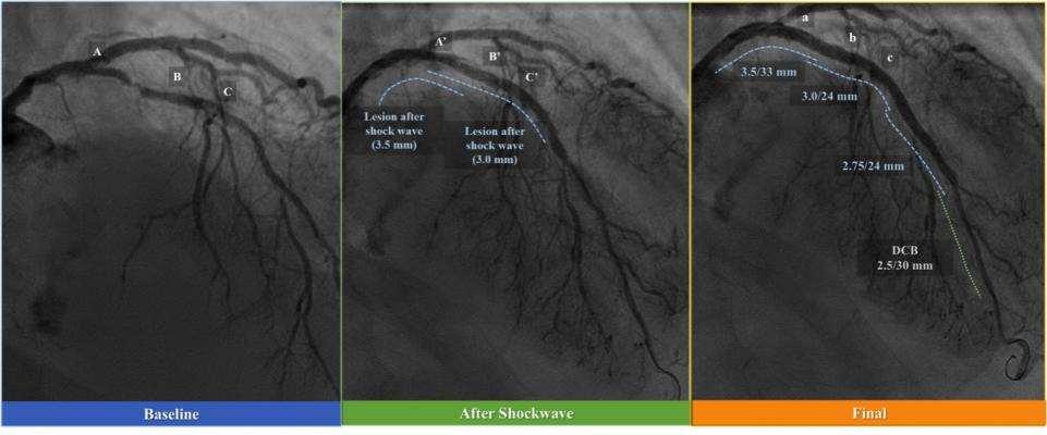 Intravascular Lithotripsy May Offer Solution for Calcified Coronary Lesions New balloon
