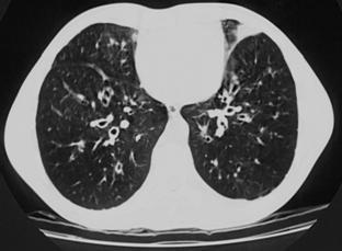 Differensialdiagnoser 31 Allergic bronchopulmonary aspergillosis (ABPA) A condition characterized by an exaggerated response of the immune system (a hypersensitivity response) to the fungus