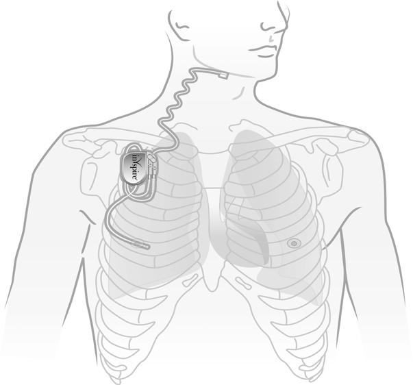 Modeller og implantatplasseringer for MR-betingede nervestimuleringssystemer Følgende tabell lister opp alle modellnumre for Inspire implanterbare pulsgeneratorer, og identifiserer de som kan