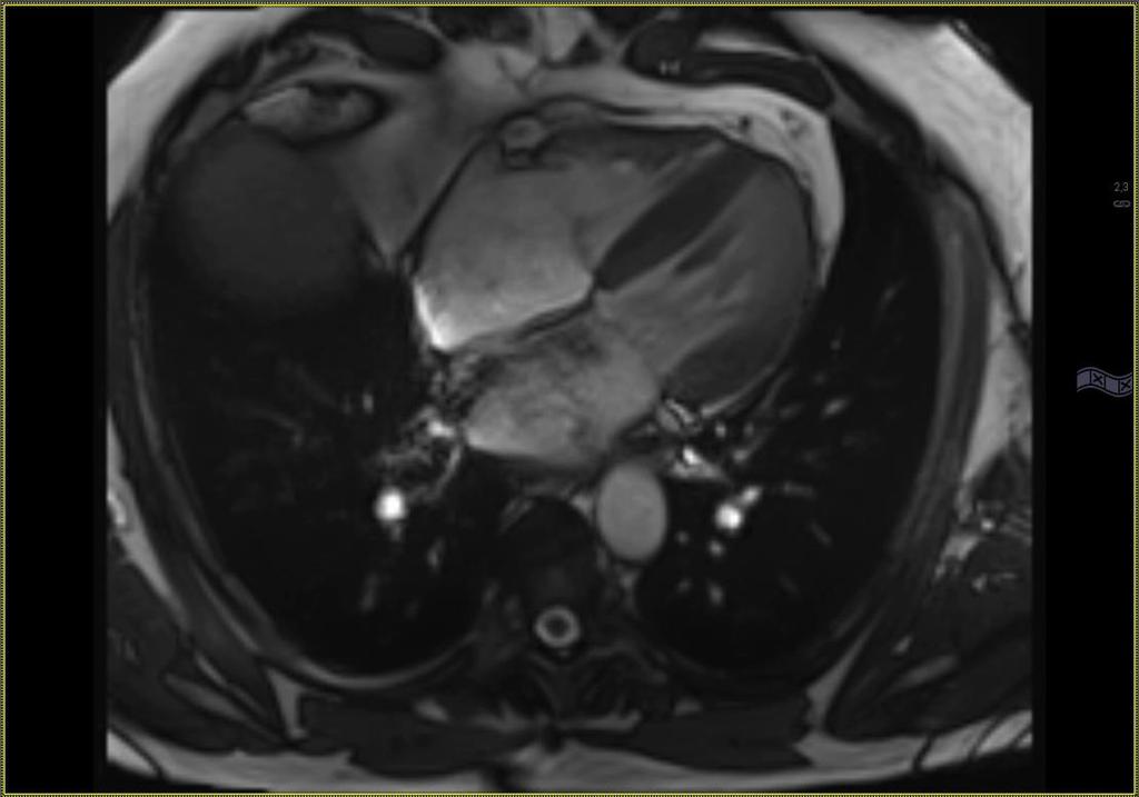 MR hjerte Indikasjoner Myokarditter Kardiomyopatier Funksjonsvurderinger ved suboptimal ekko