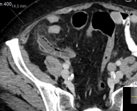 Akutt radiologi på vakt Økt døgnaktivitet Tilstedevakt LIS fra 2014. De fleste akutt kirurgiske pas.