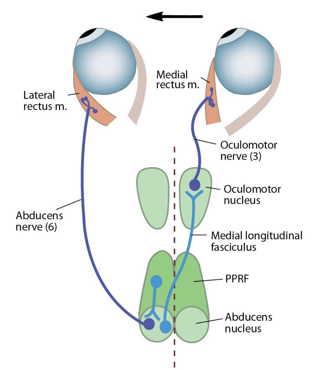 Kontroll av horisontale konjugerte øyebevegelser Figuren illustrerer hvordan skade av fasciculus longitudinalis medialis fører til blikklammelse i medial retning på samme side som skaden sitter