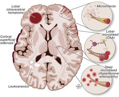 Cerebrale mikroblødninger en diagnostisk utfordring?