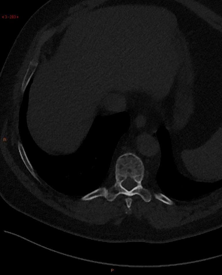 CT ved myelomatose God på