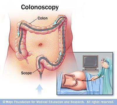 Colonoskopi er indisert Alder > 50 Familiehistorie på IBD eller colorectal cancer Ved