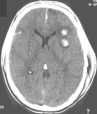 Cerebral CT 3