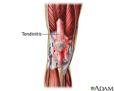 Avlastning av leddet ofte tilstrekkelig behandling. arthritis-symptoms.com wikipedia.org Tendinitt (senebetennelse) Betennelse i en sene eller senefeste.