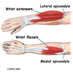 Epikondylitt Betennelse i senefestene til håndleddets strekkeeller bøyemuskler. Senene til håndleddets strekkemuskler fester seg på utsiden av albuen (laterale epikondyl).