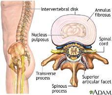 Akutt lumbago (hekseskudd) Skyldes tilstander i ryggsøylens ledd, mellomvirvelskiver og muskulatur.