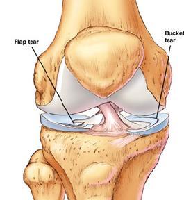 Meniskdegenerasjon Akutt meniskskade er vanlig hos unge idrettsutøvere, mens meniskdegenerasjon (slitasjeskade) oppstår oftest etter 40-årsalderen. Smerter i kneet. Følelse av at kneet svikter.