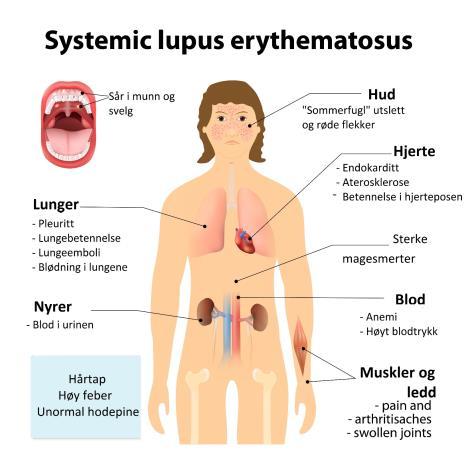 Systemisk lupus erythematosus Bind 2 side 66 Systemisk lupus erythematosus (SLE) er en kronisk, tilbakevendende betennelsessykdom i bindevevet som kan gi symptomer fra mange organsystemer som hud,