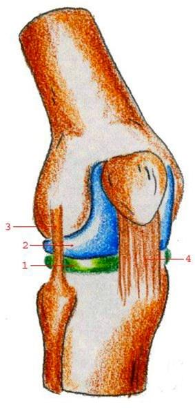 Laterale sidebånd Som regel er dette alvorligere skader enn skader på sidebåndet på innsiden av kneleddet, fordi det ved skader på sidebåndet på utsiden av kneet